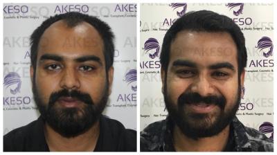 Dr. Akhilesh Jangid (@akesotransplant) / Twitter Dr. Akhilesh Jangid (@akesotransplant) / Twitter