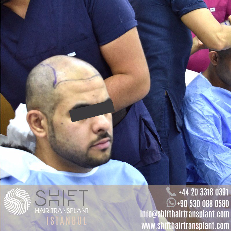 shifthairtr's tweet photo. #FUE_Hair_Transplant #Hair_Transplant #Hair_Restoration #Hair_Replacement #Hair_Transplant_for_Women #Women_Hair_Transplant #hairtransplant https://t.co/uKyzgk4gwQ