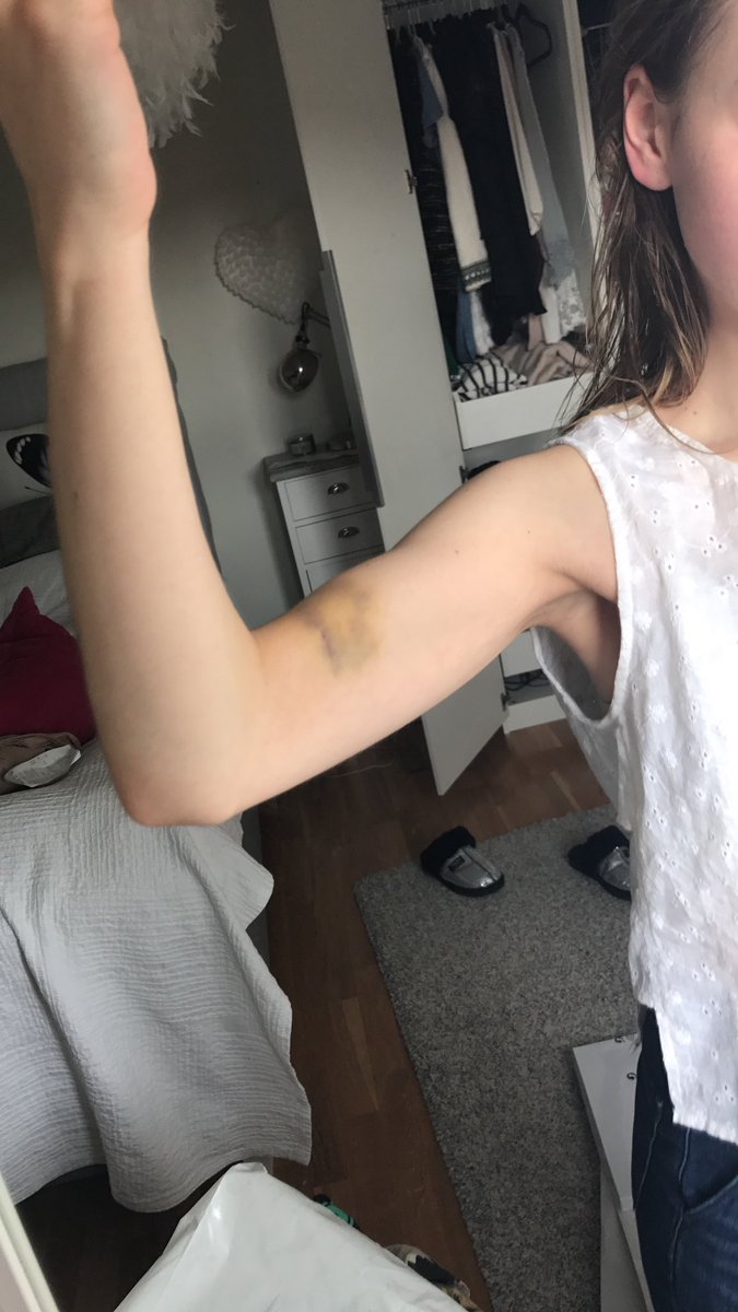 mathildaling's tweet image. Tränat så mkt biceps att muskeln sprack!!!! Hihihuhu