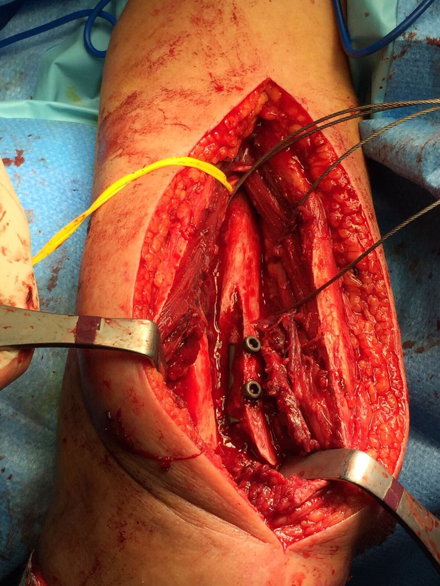 ferrando_albert's tweet photo. Fractura peri implante de hรบmero distal. Referencia del nervio radial. @ferrando_albert @alvarodaras #elbowsurgery #complexfractures https://t.co/W62J4WUZcg