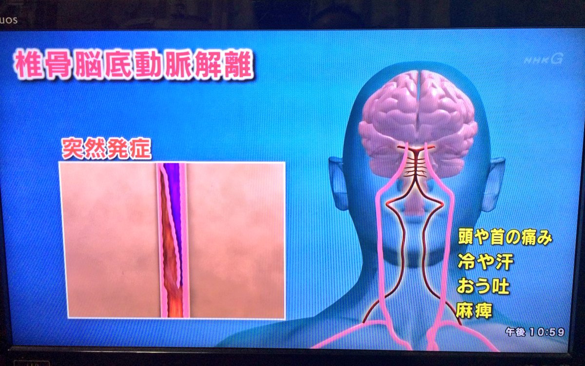 椎骨脳底動脈解離