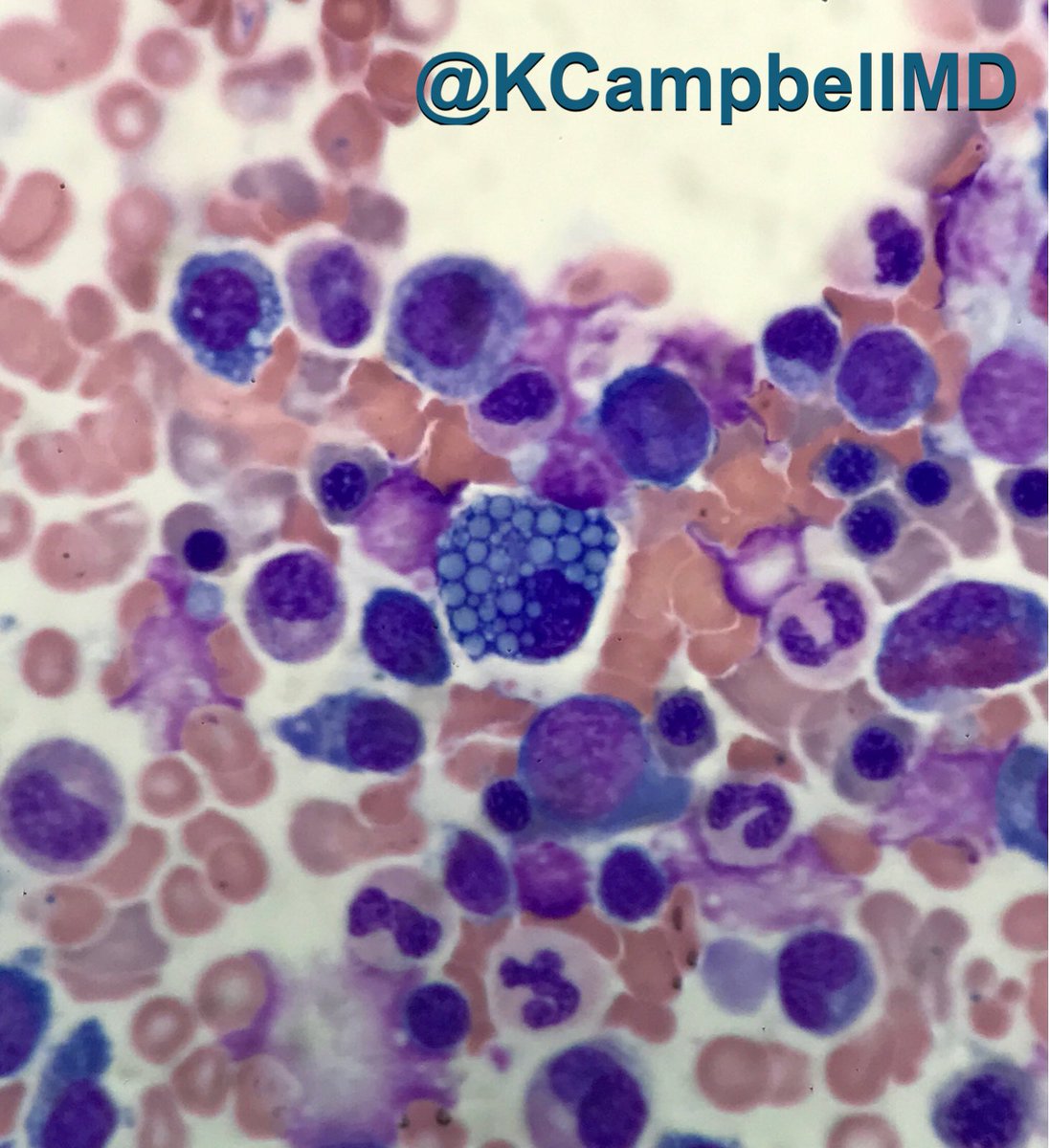 KCampbellMD's tweet photo. When you're Mott you're Mott!! @ginajohnsonmd #hemepath #mottcell https://t.co/i1MMiqd2y5