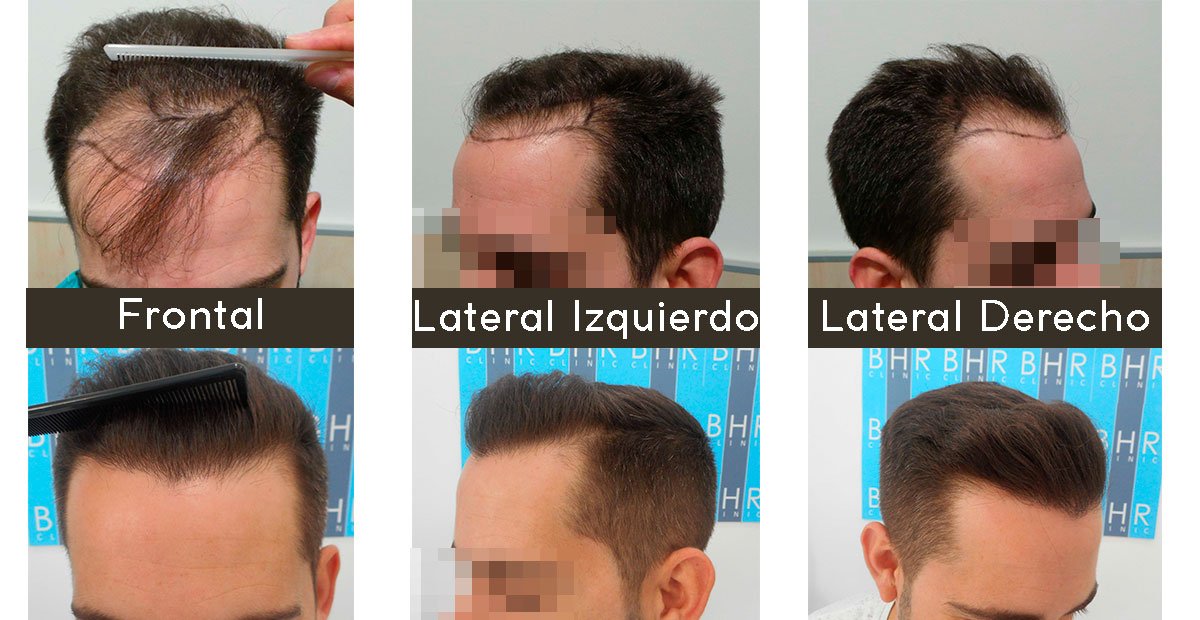 MeyeryAlcaide's tweet photo. Paciente intervenido por técnica FUE.
2000 folículos FUE.
Compartimos también su experiencia: https://t.co/XujrJZ5sCp
#injertopelo #alopecia https://t.co/ambrEdPmZ9