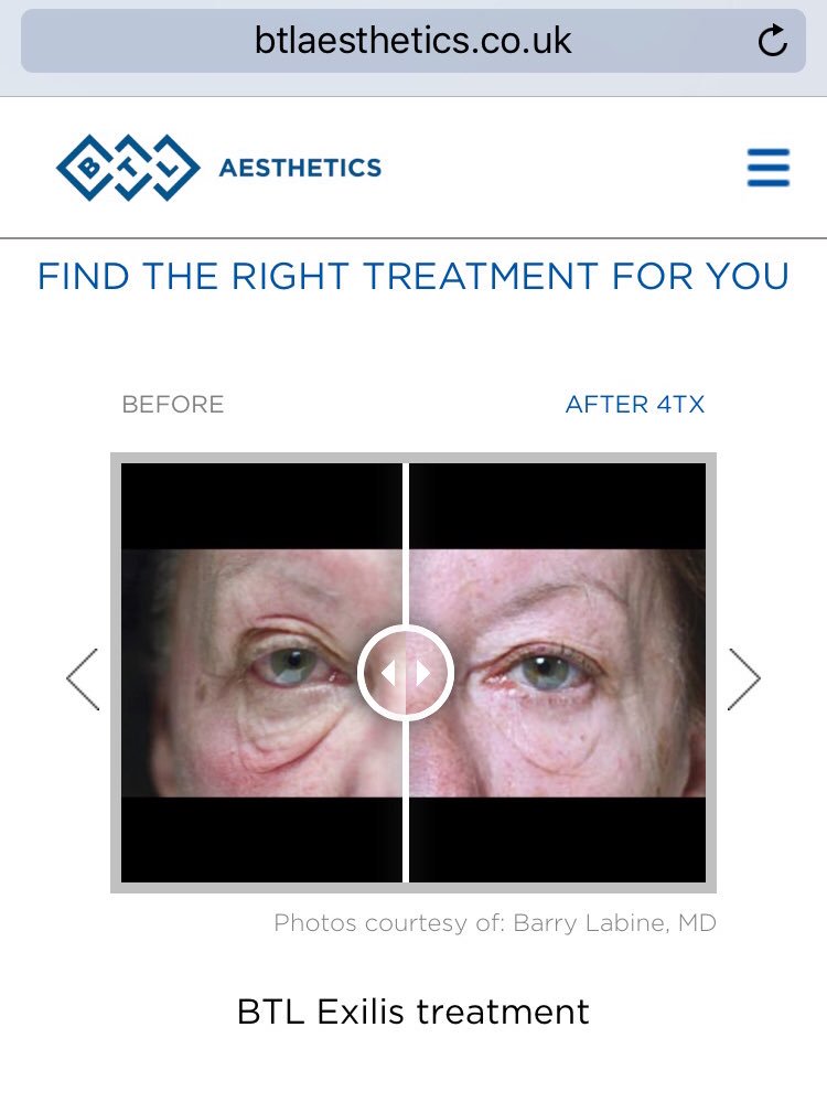 BTLAestheticsUK's tweet photo. Want amazing results but don't want cosmetic surgery? BTL Exilis Elite can target #eyes & rejuvenate them painlessly #btlexiliselite https://t.co/uNMEtZUwlD
