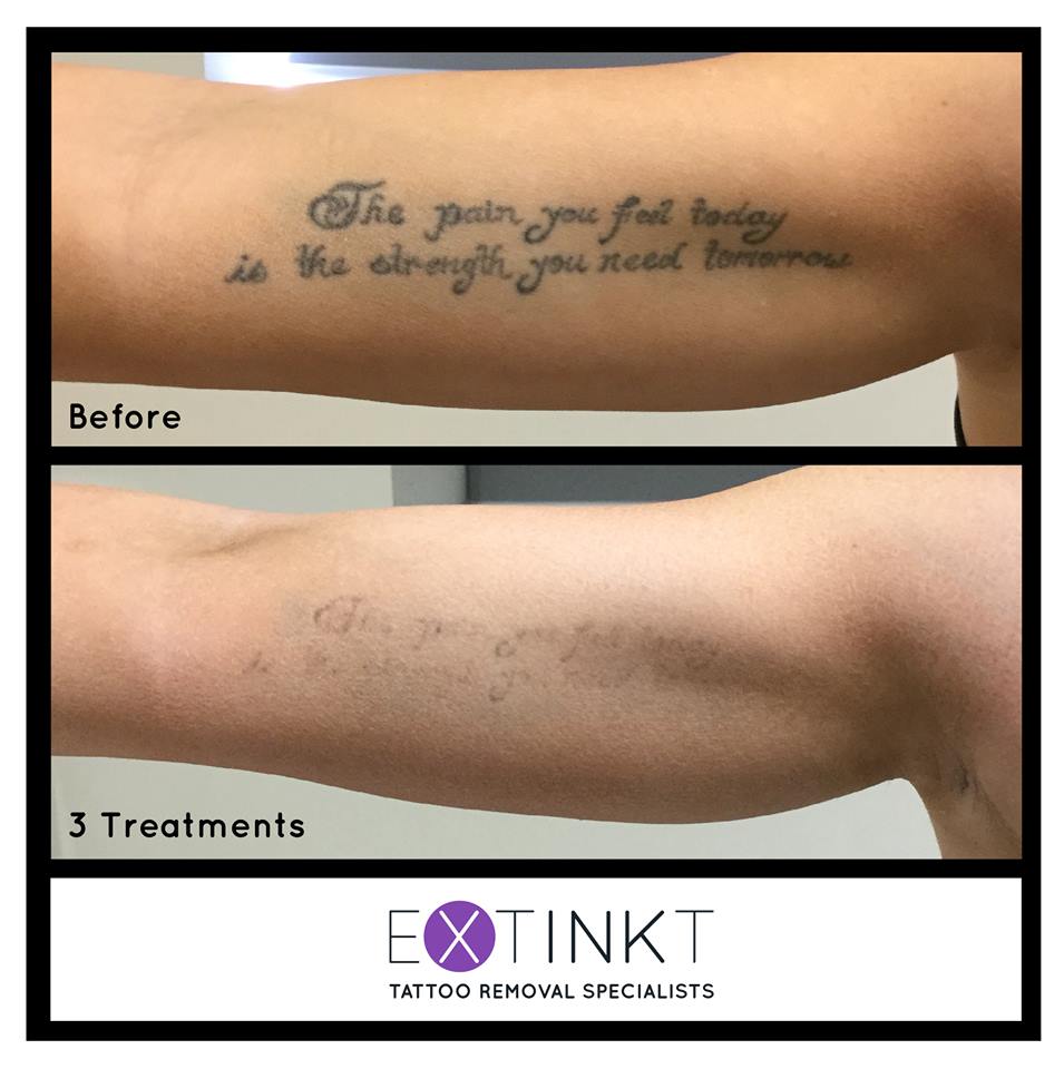 Extinkt Tat Removal (@Extinktsydney) / Twitter Extinkt Tat Removal (@Extinktsydney) / Twitter