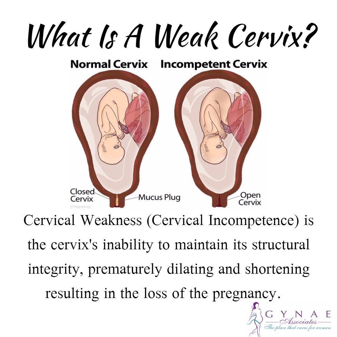 Cervix Open During Pregnancy cervix-open-during-pregnancy