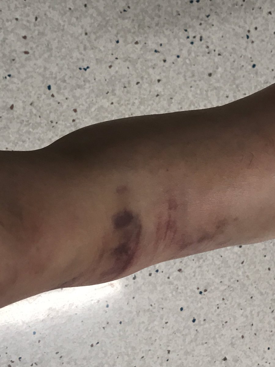SpursGrumpy's tweet photo. Here's how my work 5-a-side tournament ended. In game 2 of 6, I went over on my ankle. Played game 3 but couldn't go on. #doublefracture https://t.co/gO91uowzkk