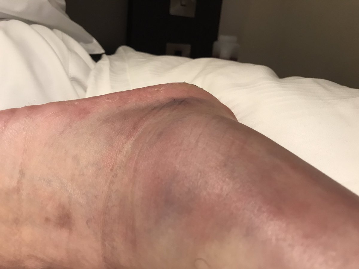 SpursGrumpy's tweet photo. Here's how my work 5-a-side tournament ended. In game 2 of 6, I went over on my ankle. Played game 3 but couldn't go on. #doublefracture https://t.co/gO91uowzkk