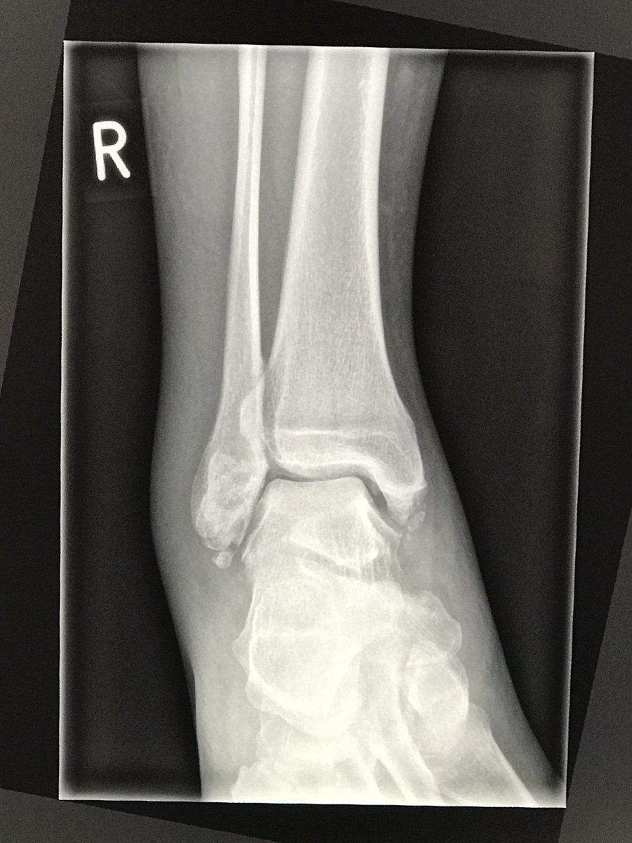 SpursGrumpy's tweet photo. Here's how my work 5-a-side tournament ended. In game 2 of 6, I went over on my ankle. Played game 3 but couldn't go on. #doublefracture https://t.co/gO91uowzkk