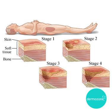 dermozone's tweet photo. Treatment for Decubitus Ulcer patient will depend on the stage of ulcer. Treatment can include medications, therapies and even surgery. https://t.co/q8dIpsIehA