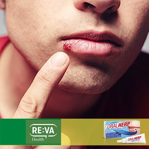 ¿Herpes labial? #OralHerp cura la herida rápidamente y calma el dolor al instante!