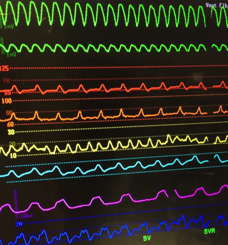 mellionaire11's tweet image. what a pretty rainbow 😂🌈 #OnlyInTheICU #vtach