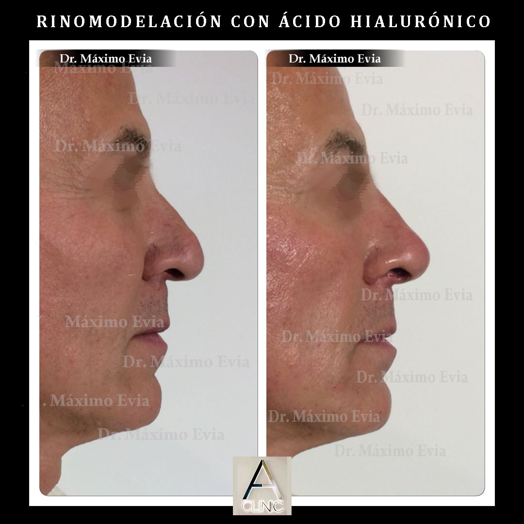 anidoHB's tweet photo. Rinomodelación con #ácidohialurónico realizada por nuestro Dr. @MaximoEvia 
#rinomodelacion #aesthetic #medicinaesteticamadrid #anidohb https://t.co/BZndbPZNMZ
