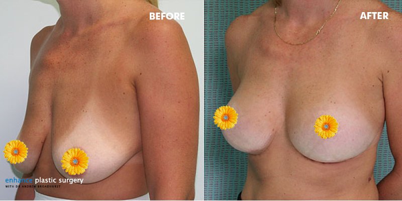 Enhanceps's tweet image. Friday inspirations! Breast augmentation and lift = beautiful transformation. What do you think?#boostedbydrbroady#drbroady
#broadhurstbabe