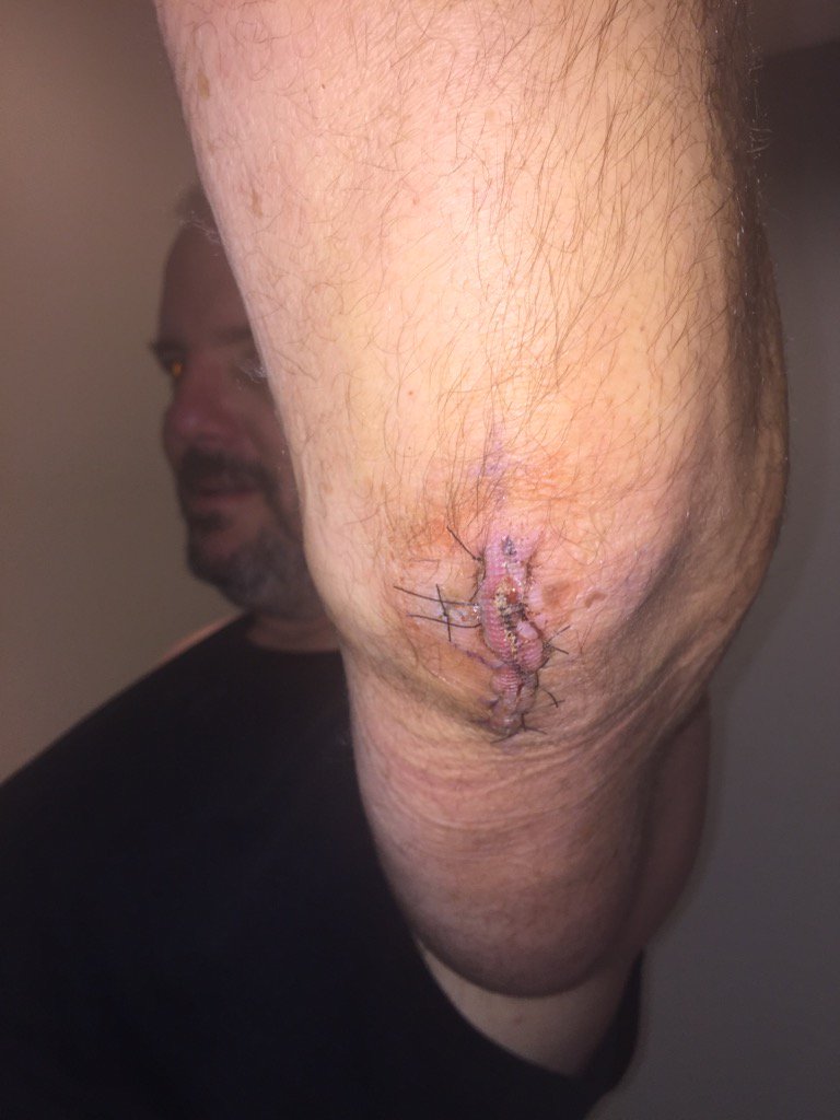 ted_schoenke's tweet photo. One week after elbow surgery #gunschoe https://t.co/BHrKKrybjB