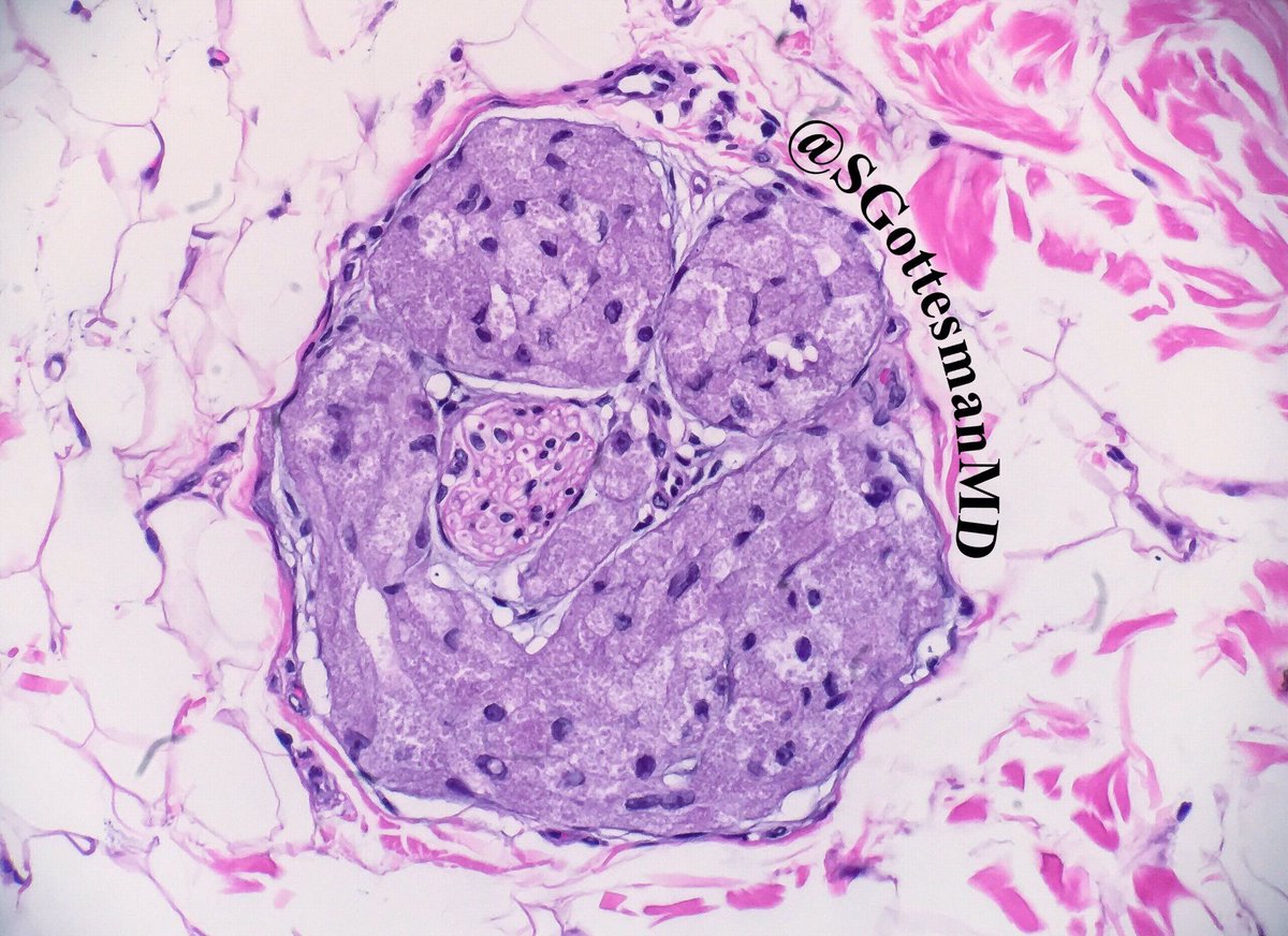 JMGardnerMD's tweet photo. Perineural involvement seen in majority of benign granular cell tumors. Do not be afraid. #Pathology #dermpath #bstpath pics: @SGottesmanMD https://t.co/pYXKA7Fg7b