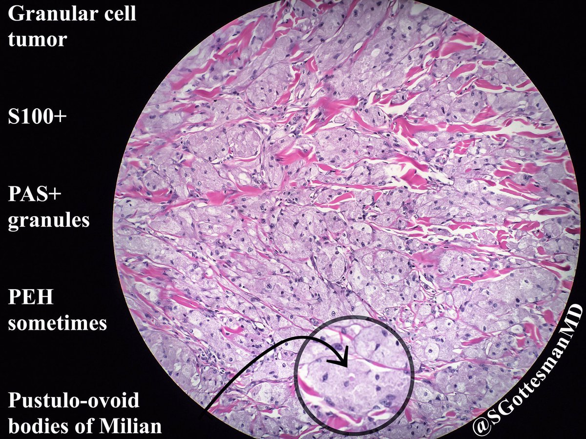 JMGardnerMD's tweet photo. Perineural involvement seen in majority of benign granular cell tumors. Do not be afraid. #Pathology #dermpath #bstpath pics: @SGottesmanMD https://t.co/pYXKA7Fg7b