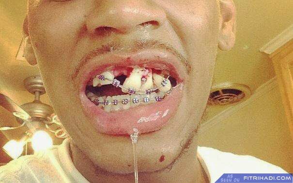 Sensitive medias coming thru ‼️ I just wanna show u guys contoh gambar bila lama pakai fake-real braces ni