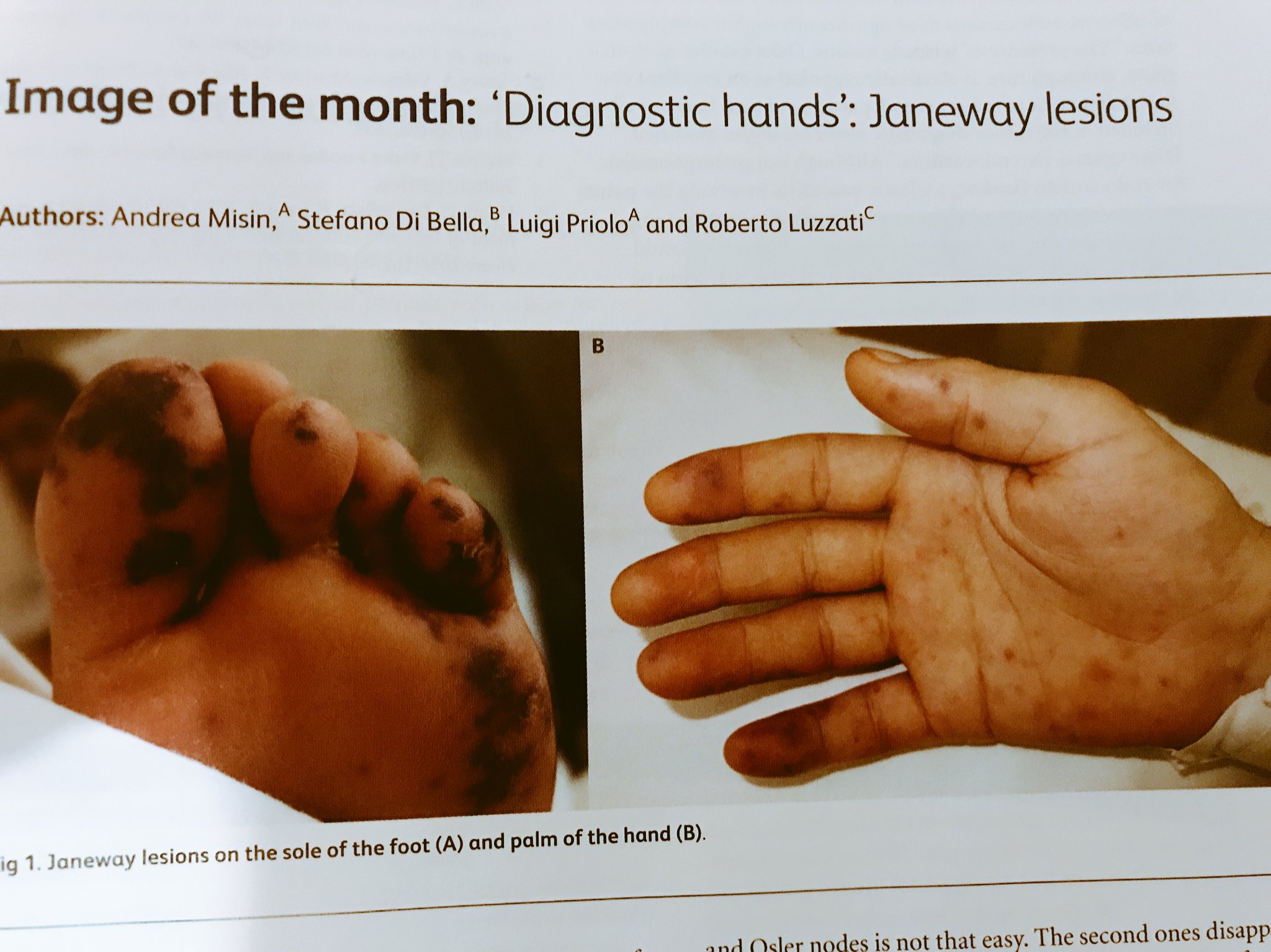 Janeway Lesions Feet Infective Endocarditis ScienceDirect