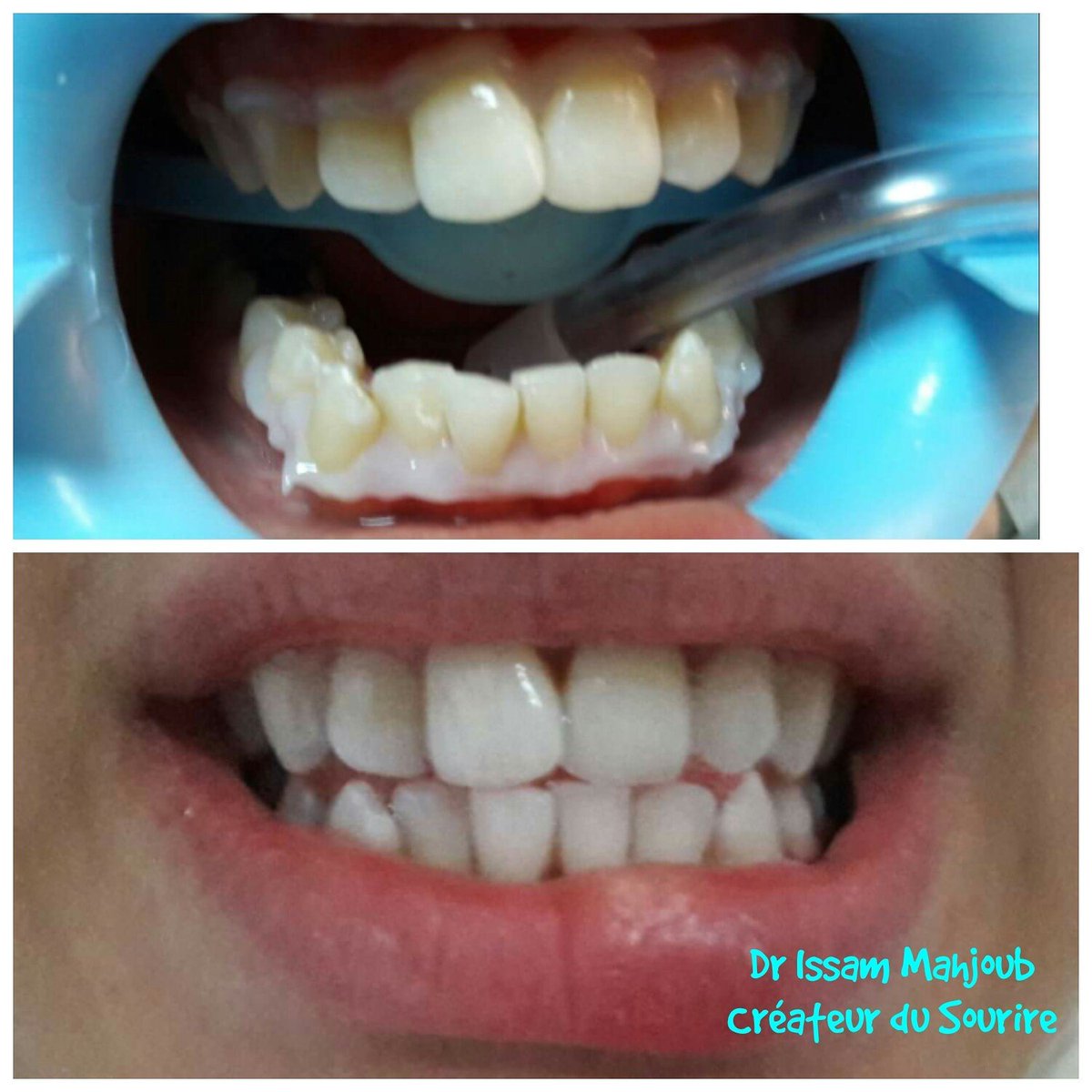 MahjoubIssam's tweet photo. Blanchiment dentaire
#blanchiment #whitening #starsmile #smilecentre #msaken #tunisia #tunisie https://t.co/ZmBz7QyW8d