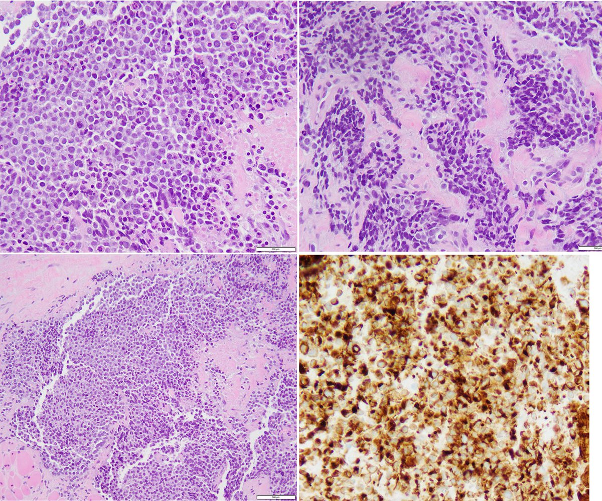 BinXu16's tweet photo. Sinonasal lesion in a teenager boy. Guess the Dx and IHC? #ENTpath #Pedipath @bansar_bansaria @VijayPatho @amy_treece13 @mreyesm @kriyer68 https://t.co/mxZTV1Ahtx