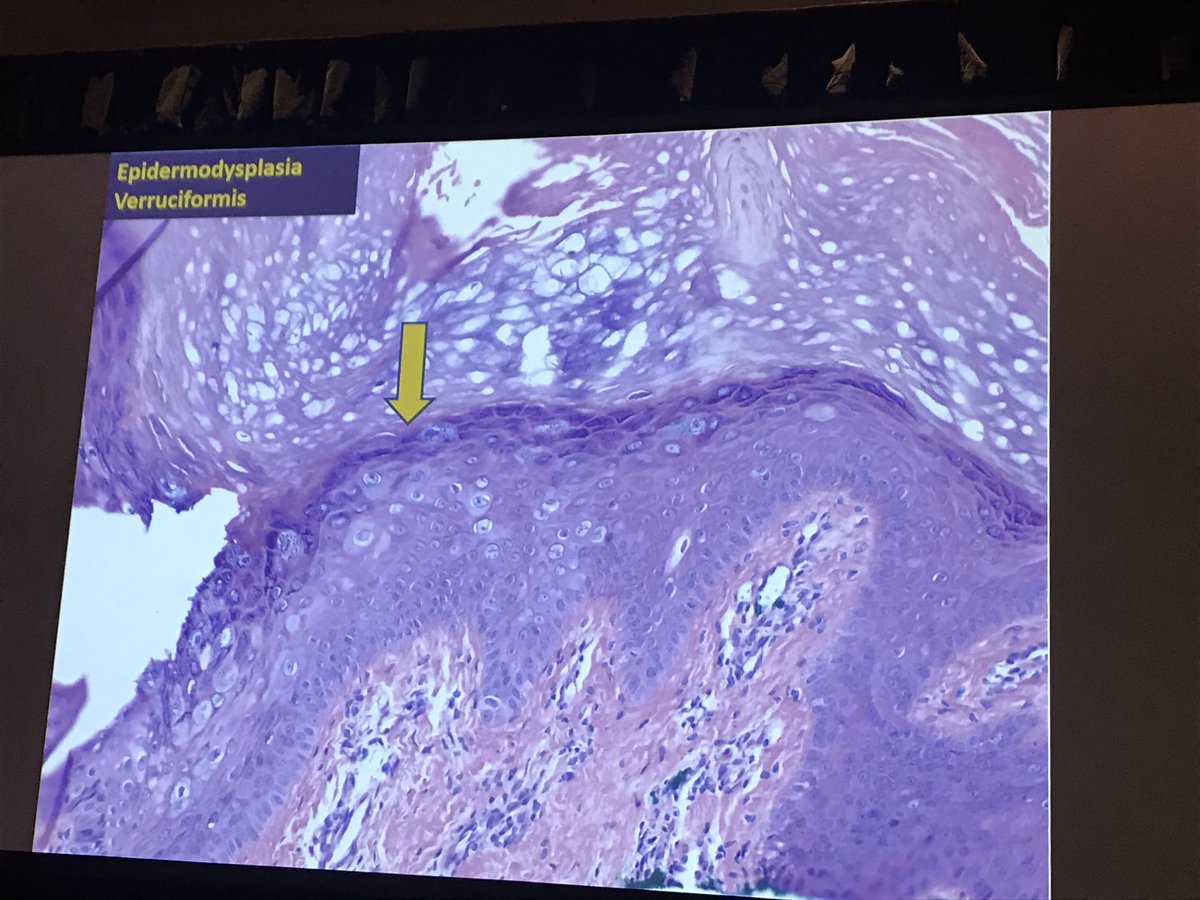 EDV can mimic Bowen's disease &amp; extramammary Paget's #dermpath #boardfodder #pathpearls #dermatology #PracticalSymposium17