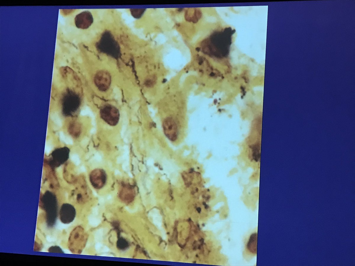 The great imitator = syphilis can have many histological patterns. Warthin-Starry stain #dermpath #PracticalSymposium17 @PrDermSymposium