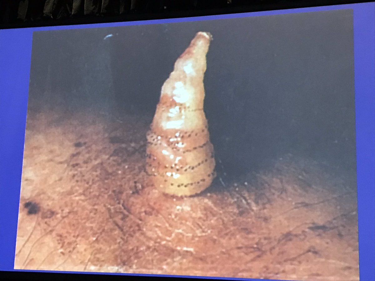 AnnieMorrisonMD's tweet photo. Cutaneous myiasis "Maggots will grow in your skin!" -@ClayCockerell #PracticalSymposium17 #dermatology #dermpath #infectiousdisease https://t.co/IUqBL5uqqW
