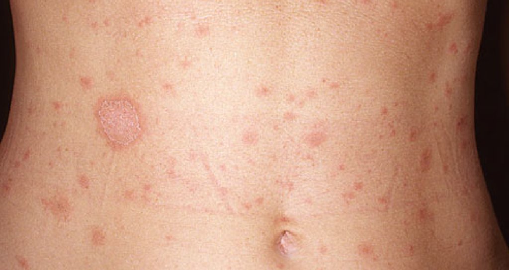 A harmless rash, pityriasis rosea usually begins as a single scaly
