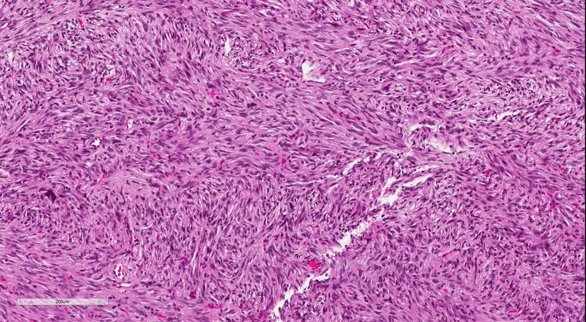afgao's tweet photo. Pituicytoma, TTF1 IHC. Forms spectrum with SCO, GCT of neurohypophysis, and sellar "ependymoma" #WSI: https://t.co/Vh739QgrX8 #neuropath https://t.co/7zqEjml9h4