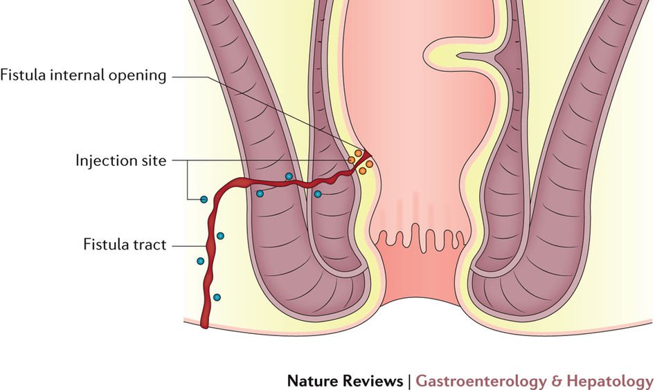 NatRevGastroHep's tweet photo. New Review! Panes &amp; Rimola give an up-to-date overview on perianal #fistulizing #Crohns disease. Find it here: £ https://t.co/dPmCaYvrIi https://t.co/VgZYmtEVLh