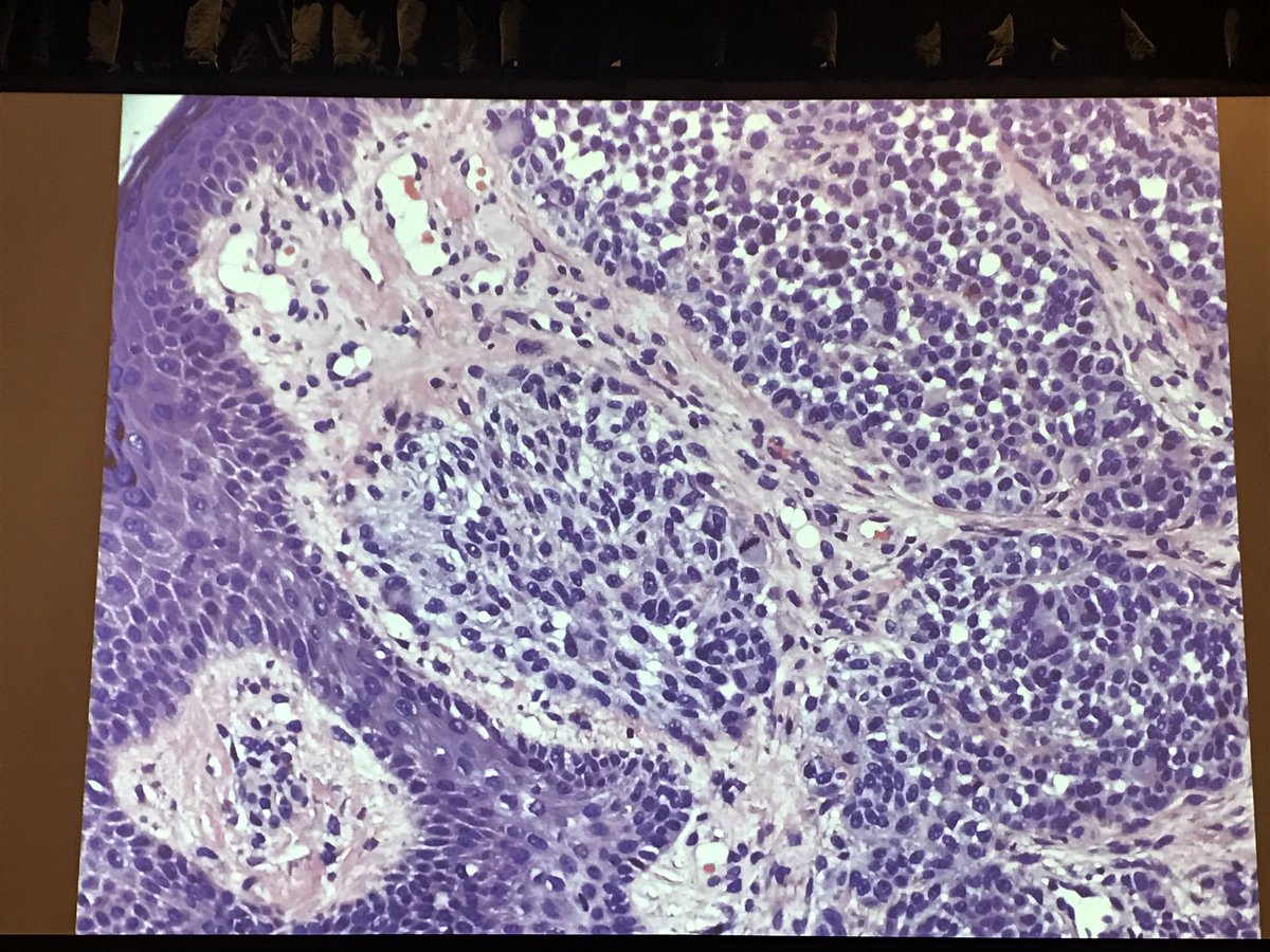 AnnieMorrisonMD's tweet photo. Great case of nevoid melanoma from Dr Whitney High @PrDermSymposium #PracticalSymposium17 #dermpath #pathology #dermatology https://t.co/I5RtYvoOVd