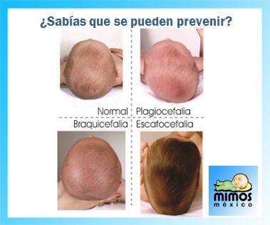 Cojin Mimos Mexico on X: Las deformidades craneales posicionales en bebes  se pueden prevenir con el cojin Mimos. #cojinmimos #bebes #plagiocefalia   / X