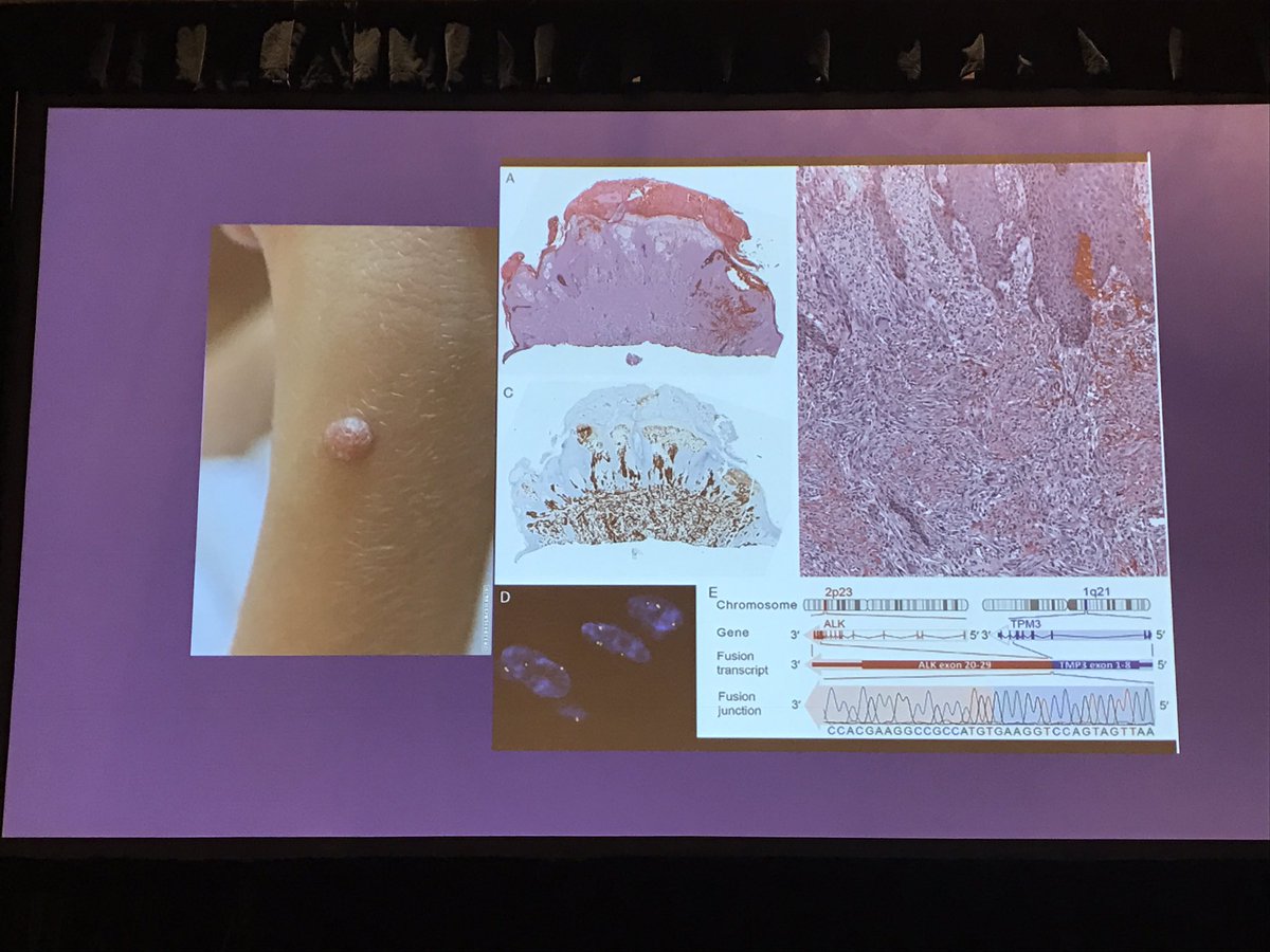 Annie O. Morrison MD (@anniemorrisonmd) on Twitter photo ALK mutations in Spitz nevi have characteristic spindle cells <a href="/ClayCockerell/">Clay Cockerell</a>'s lecture at #PracticalSymposium17 #dermpath #dermatology ALK mutations in Spitz nevi have characteristic spindle cells <a href="/ClayCockerell/">Clay Cockerell</a>'s lecture at #PracticalSymposium17 #dermpath #dermatology