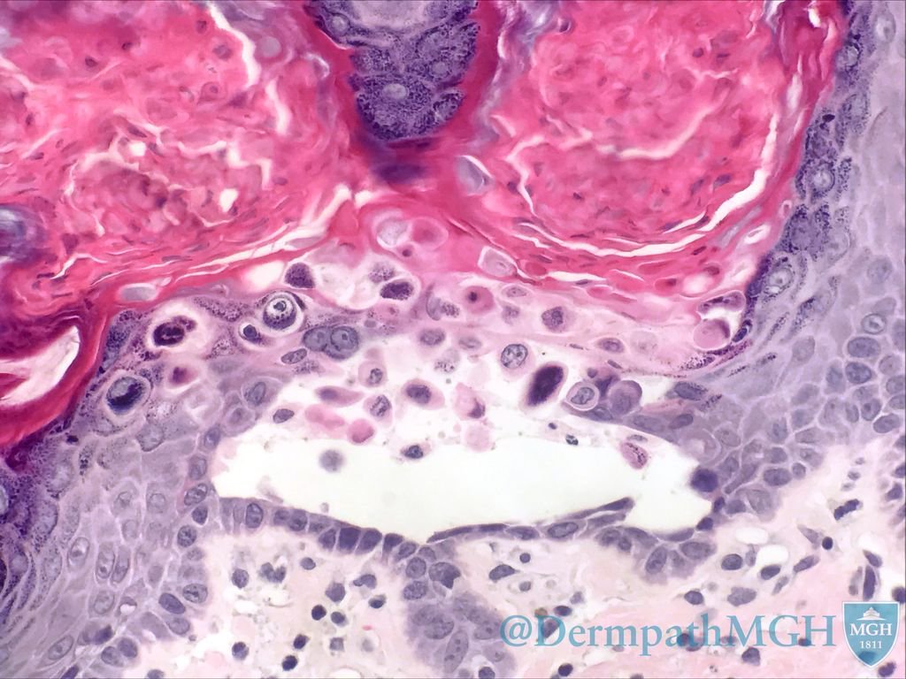 Corps ronds and grains of Darier. Greasy papules &amp; plaques: Darier's disease, autosomal dominant (yet 47% have no family Hx) #Dermpath #Path