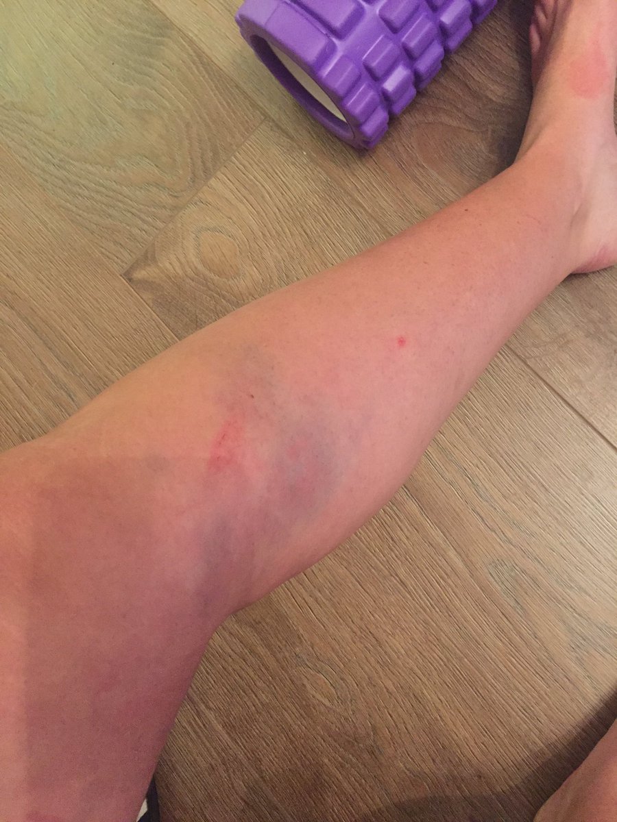 ajgreenslade's tweet photo. Great to be back playing today.... have not missed these though 🙈 #defenderproblems #preseason #bruiselikeapeach https://t.co/uMwzSVM5Mm