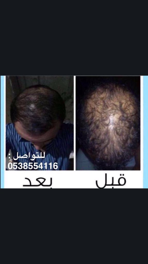 7iiff's tweet photo. زيت الحشيش الافغاني 💯
لجميع مشاكل الشعر والدقن
صلع ،تساقط ،تنعيم ،تطويل
الرياض يد بيد 🚗
باقي مدن المملكه شحن
للتواصل 📲0538554116
 #أحبك_لأنك https://t.co/P5oUmTWZPi