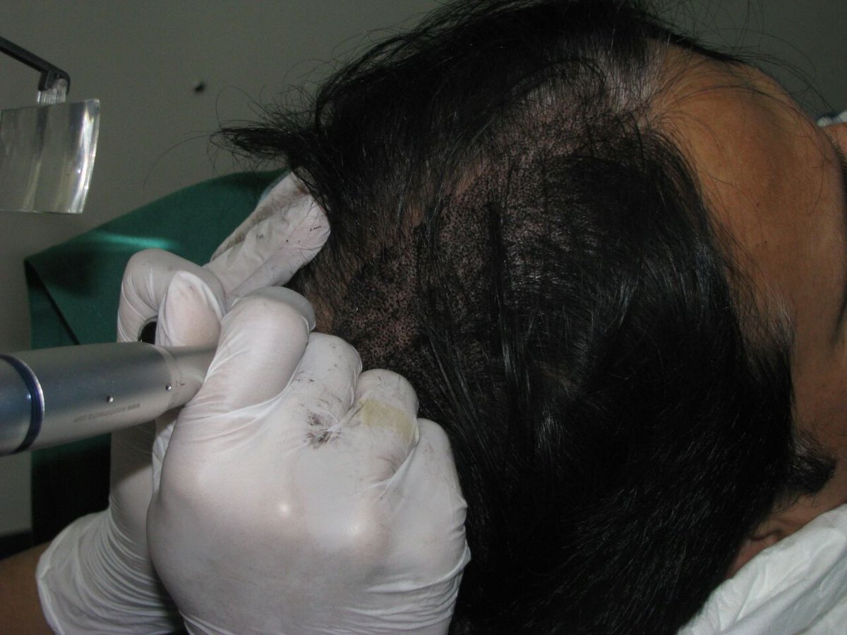 #SMP Scalp,micropigmentation after Hair Transplantation  improved aesthetics and density 
@ Cosmetic Surgery  Institute  www,csisite,com