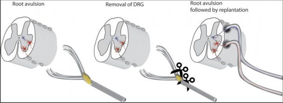 brainspine's tweet photo. New surgical strategy offers hope for repairing #SpinalInjuries https://t.co/2Exu2Bs6GU Great piece of #neuroscience news to start the week! https://t.co/uYIgOA9jKP