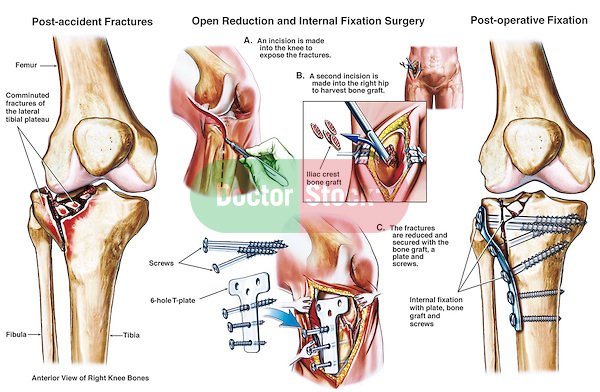 bone_reports's tweet image. #fracture #pelvicbones #Injuries #Rickets #osteomalacia
For related articles go through the below link.
bone.imedpub.com