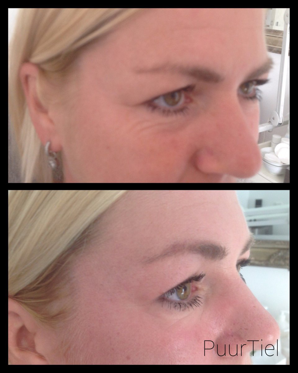 puurtiel's tweet photo. #naturalfacelifting #collagenbooster #tonebooster #antiageing #directresultaat https://t.co/BkU8vqSgI0 https://t.co/sjSXdqOWEP