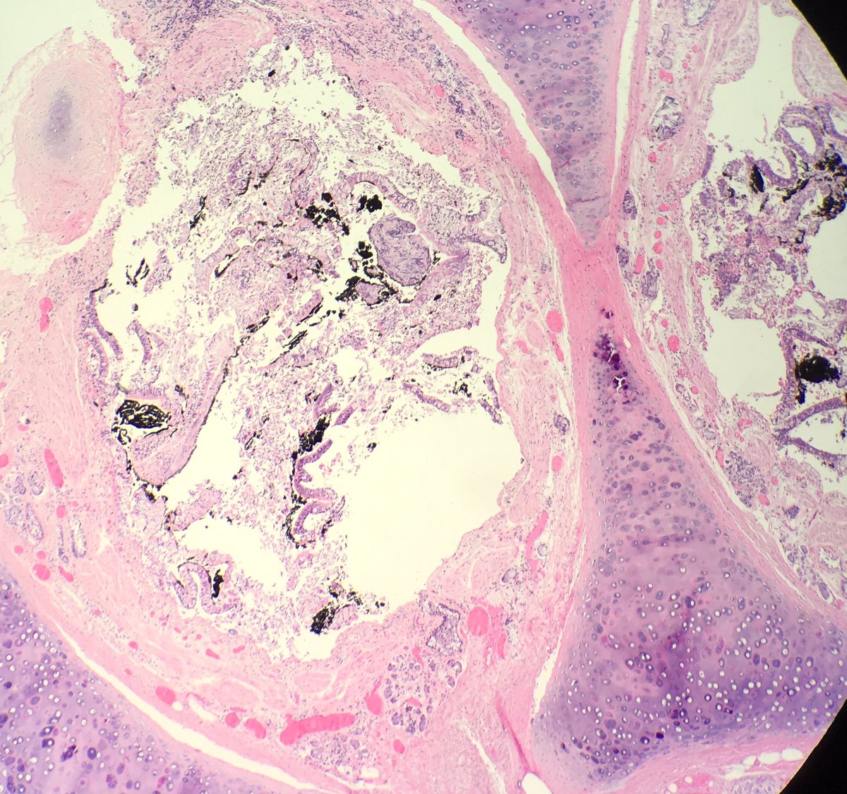 seattlequinns's tweet image. Alive or not alive in fire? #pulmonarypath #forensicpath #forensics