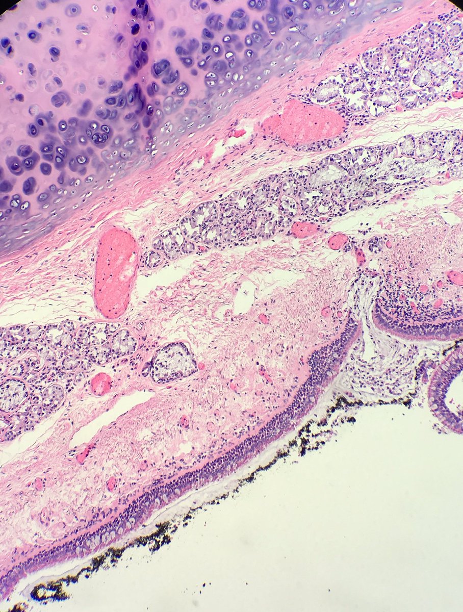 seattlequinns's tweet image. Alive or not alive in fire? #pulmonarypath #forensicpath #forensics