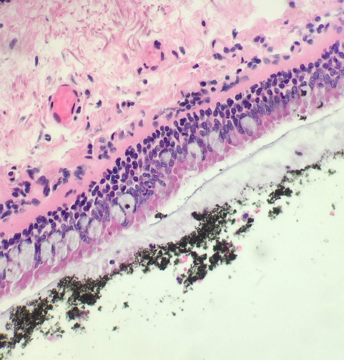seattlequinns's tweet image. Alive or not alive in fire? #pulmonarypath #forensicpath #forensics
