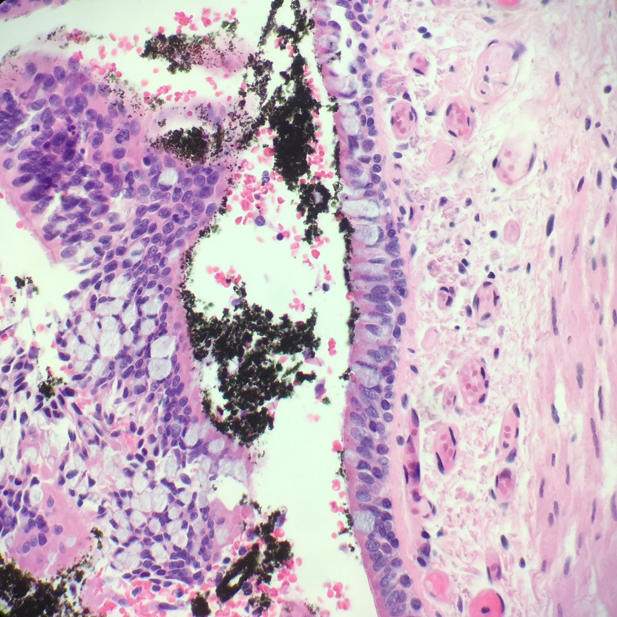 seattlequinns's tweet image. Alive or not alive in fire? #pulmonarypath #forensicpath #forensics