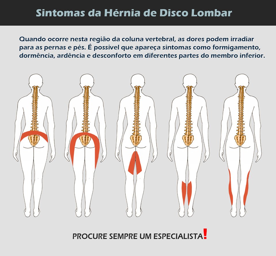 sintomas de hemangioma coluna lombar