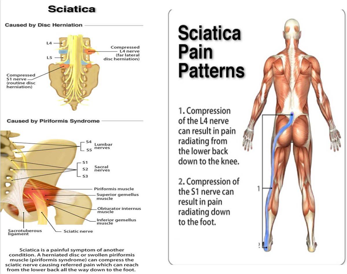 JosephEHolcomb3's tweet image. Sciatica SOS System is amazingly effective on Sciatica. #sciaticasolutions #sossciatica Find out why here: snip.ly/vnw9m