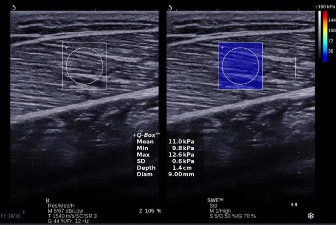 SuperSonicFr's tweet photo. Assessment of the mechanical properties of the muscle-tendon unit by #ShearWave #Elastography:.. Free full text ➡️ https://t.co/QQWjrBcZps https://t.co/YCTXkNpRqp