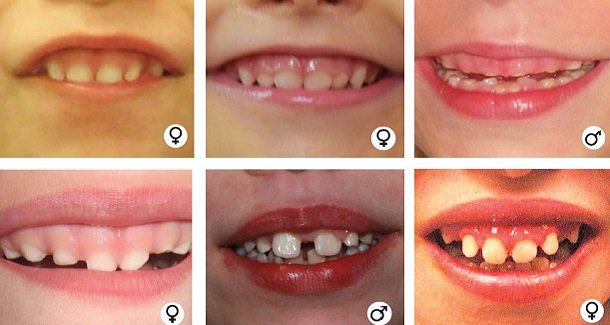 WDR26 #haploinsufficiency may cause abnormalities in facial features. > Read more: bit.ly/2uN1GDD