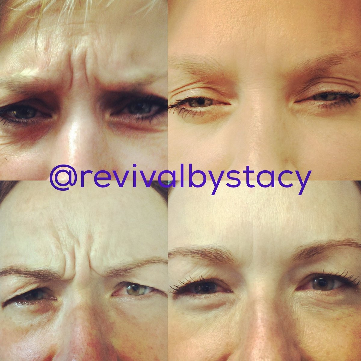 RevivalbyStacy's tweet photo. Fix your furrow! We have 4 spots left to receive $50 off your Dysport treatment this Friday! Call 719.590.9618 #frownlines #dysport #botox https://t.co/eWByFQvzh9